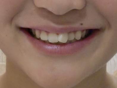 【部分矯正】 上の前歯の段差が気になる（10代・女性） 金額:14万円