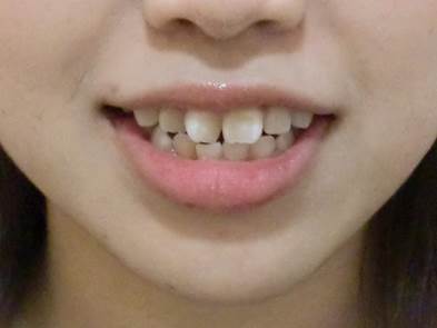 【部分矯正 裏側】 前歯の歯並びを治したい（20代・女性） 金額:24万円