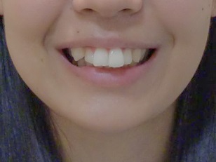 【全体矯正】 出っ歯と全体の歯並びが気になる（20代・女性） 金額:50万円