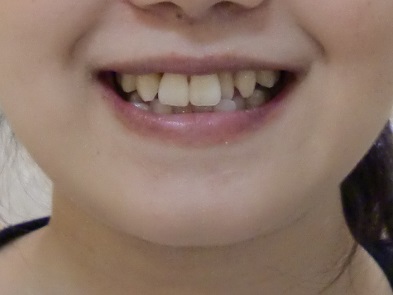 【全体矯正】全体の歯並びと八重歯が気になる（30代・女性） 金額:53万円