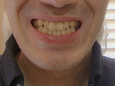 【全体矯正】全体の歯並びと八重歯が気になる（30代・男性） 金額:53万円