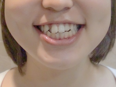 【全体矯正 裏側】全体の歯並びが気になる（20代・女性） 金額:65万円