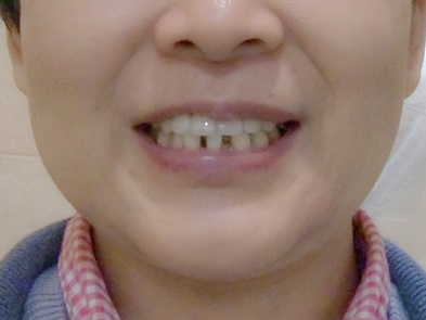 【部分矯正】下の前歯の歯並びが気になる（50代・女性） 金額:14万円