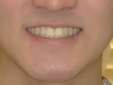 【部分矯正】上の前歯の歯並びが気になる（10代・男性） 金額:15万円